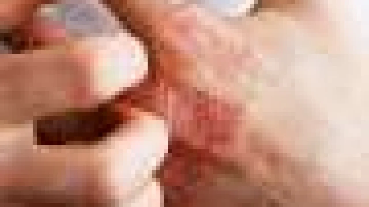 Eczema injectable drug provides quick itch relief, clinical trial results show